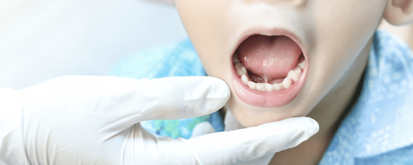 Tongue-tieLip-tie treatment Melbourne